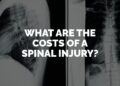 What Are the Lifetime Costs of a Spinal Cord Injury?
